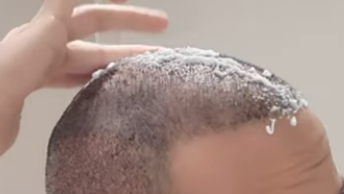 man applying lotion to his scalp post hair transplant