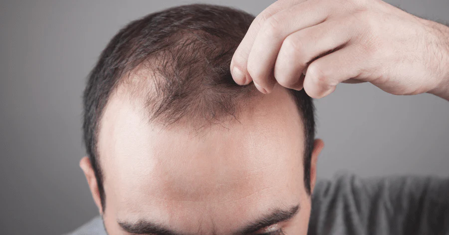 man picking at receding hairline