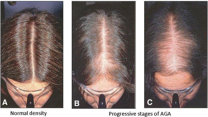 normal hair vs female pattern hair loss stages