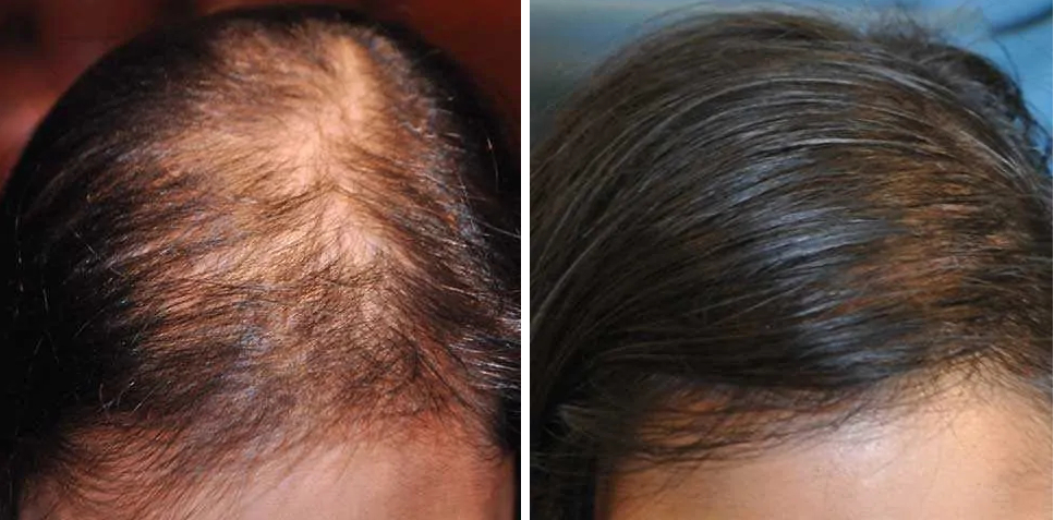 patient before and after female hair transplant