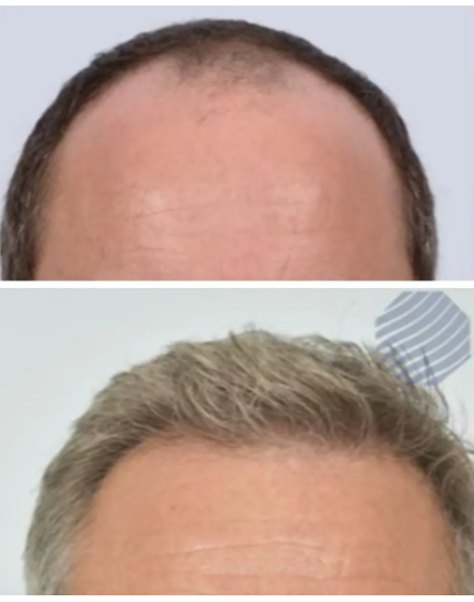 patient before and after hair transplant