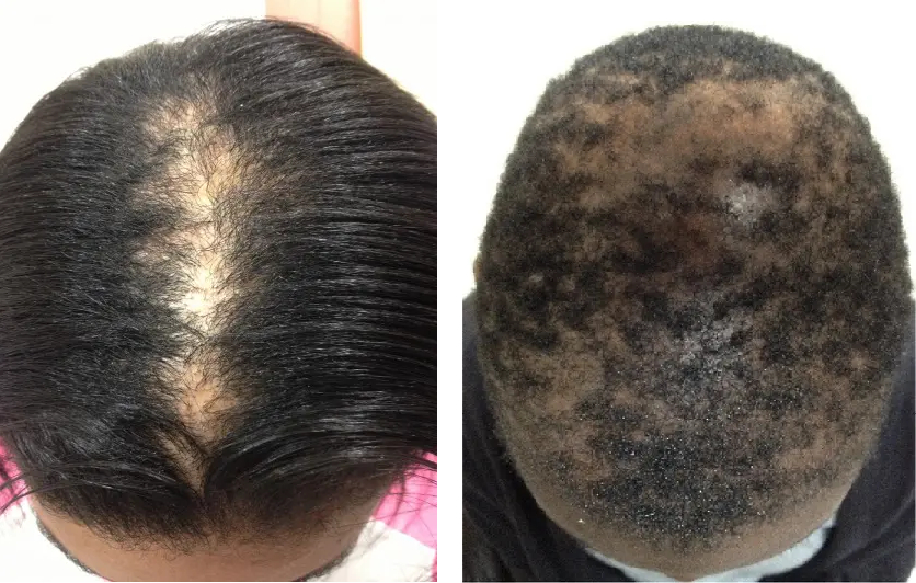 patients with scarring alopecia