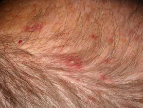 pimples on the scalp