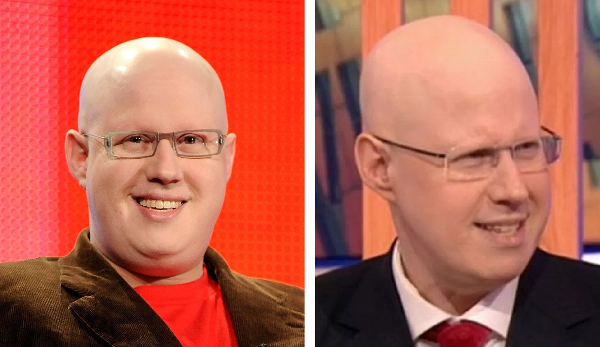 Matt Lucas bald