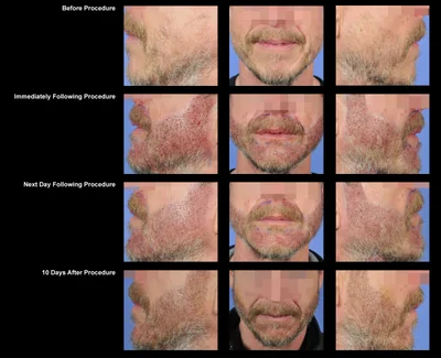 progress of a beard transplant