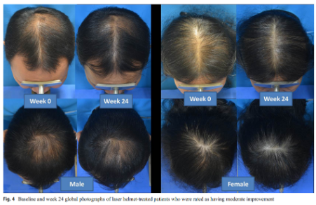 Before and after 24 weeks of red light therapy