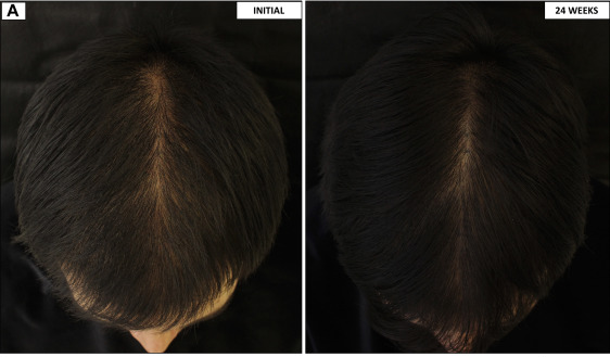 results of taking 0.25 mg of oral Minoxidil for 24 weeks