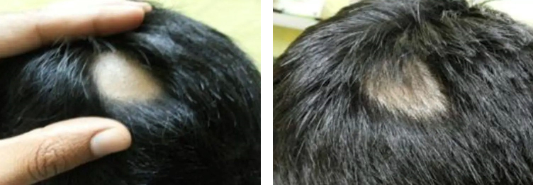 results of using 2% Minoxidil on alopecia areata for 12 weeks