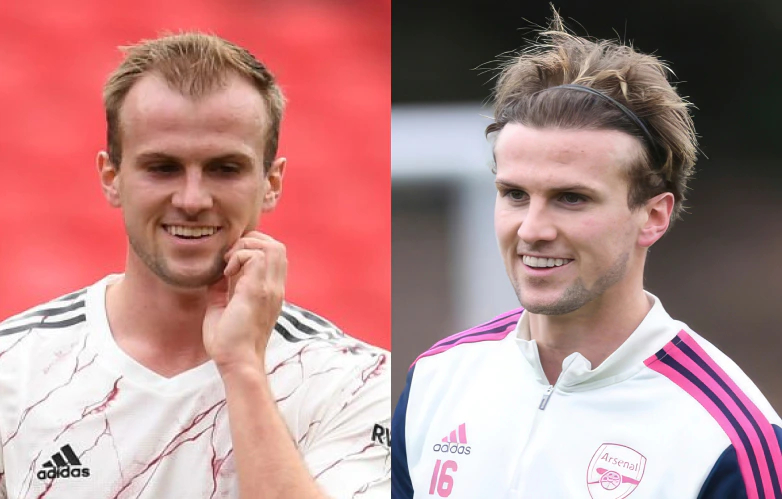 rob holding before and after hair transplant