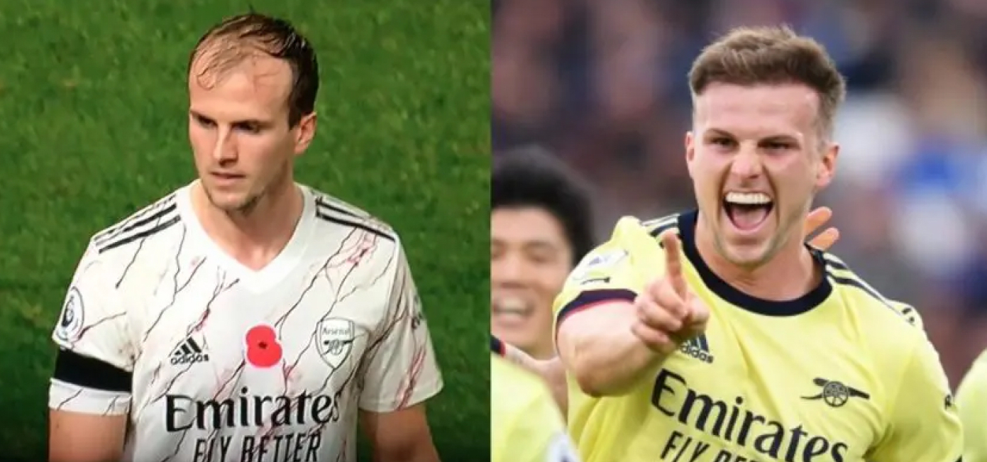 Rob Holding before and after hair transplant