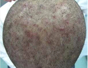 Folliculitis Nhs Featured Image