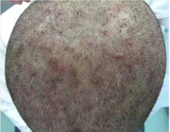 Folliculitis Nhs Featured Image