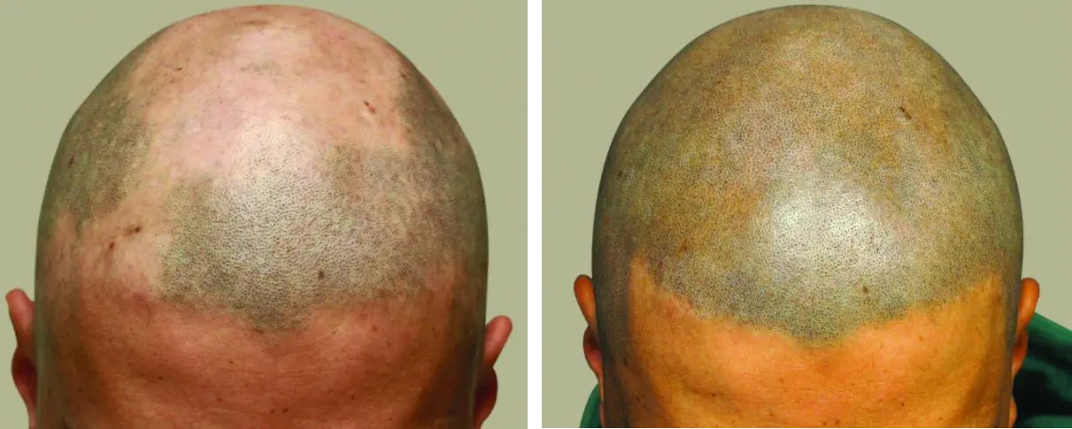 scalp micropigmentation before and after