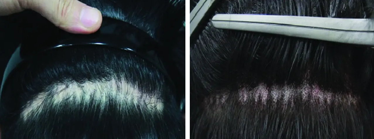 scalp micropigmentation on FUT scar