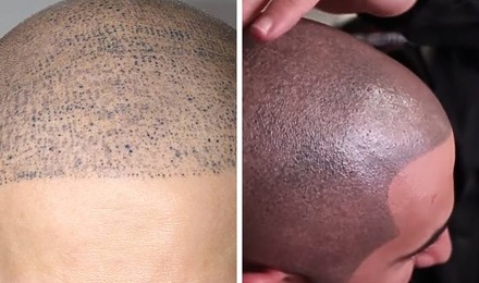 Scalp Micropigmentation Regrets Featured Image