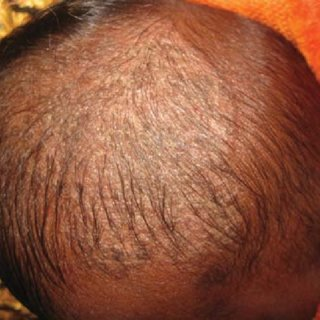 Example of cradle cap