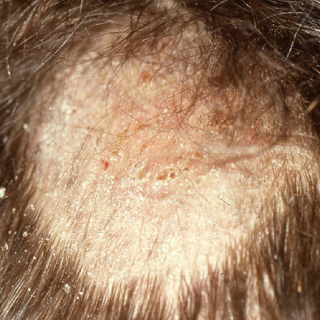 Example of Tinea Capitis