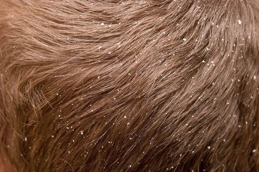 example of dandruff in hair