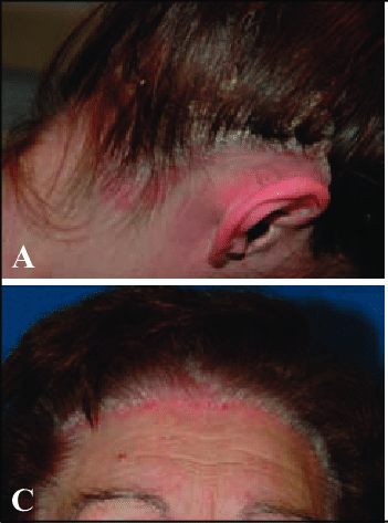 Psoriasis skin rashes on the hairline