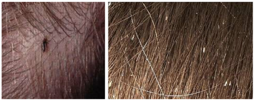 Head lice and nits in hair