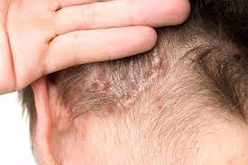 scalp psoriasis