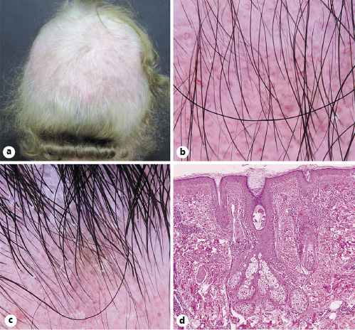 scalp symptoms of dermatomyositis