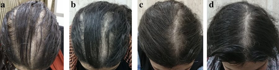 severe fphl minoxidil results before and after