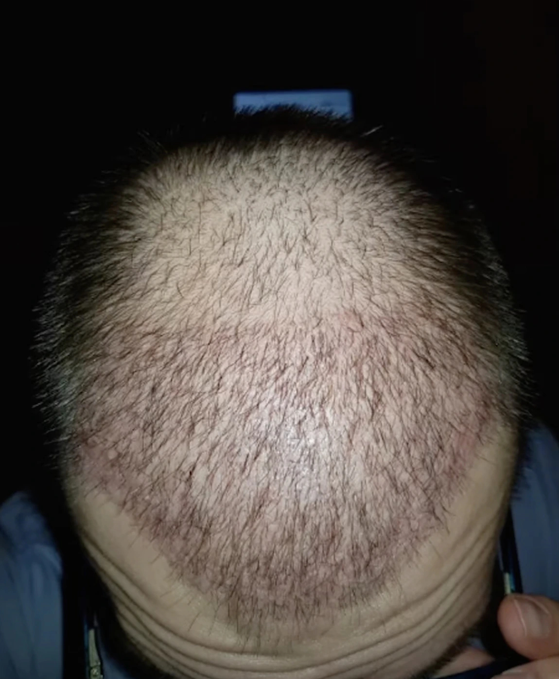 shedding after a hair transplant