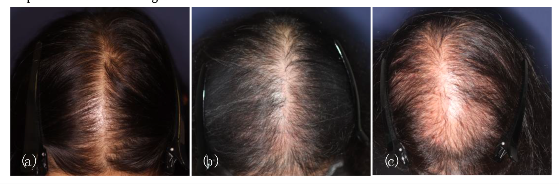 stages of female pattern hair loss