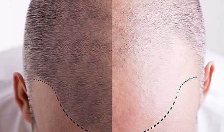 Scalp Micropigmentation (SMP): Everything You Need To Know