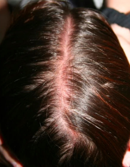 sunburn on scalp