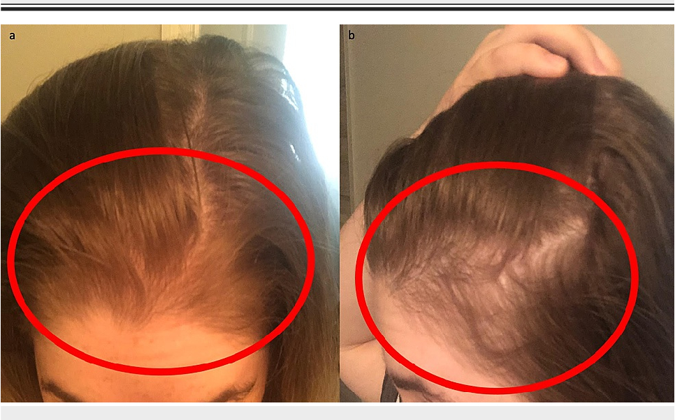 temporary hair loss after bariatric surgery