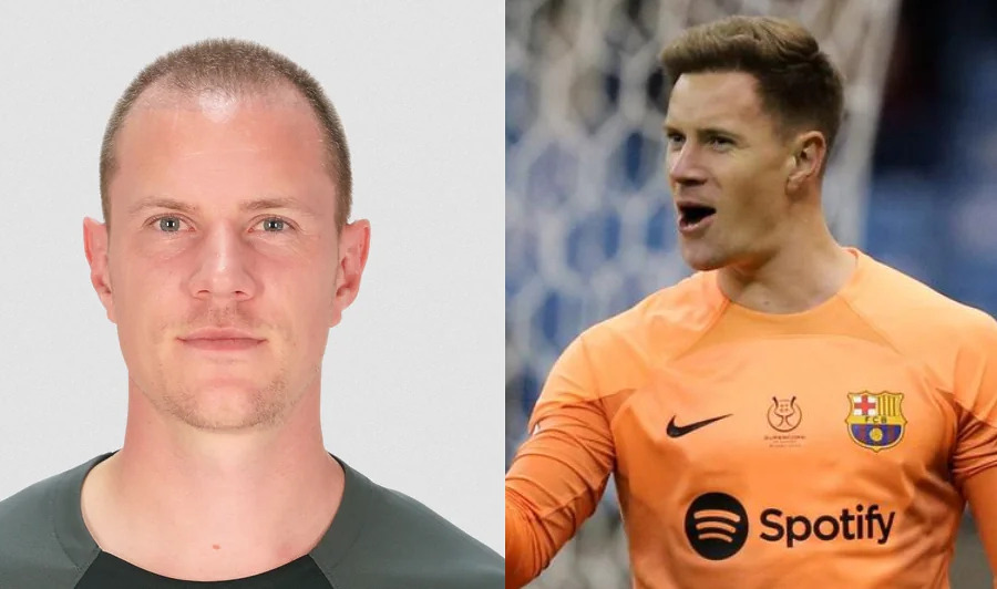 Marc-Andre Ter Stegen Hair Transplant Featured Image