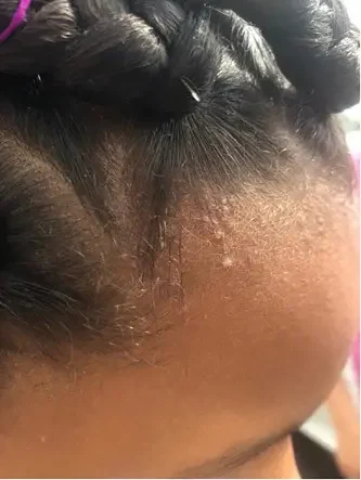 traction alopecia example