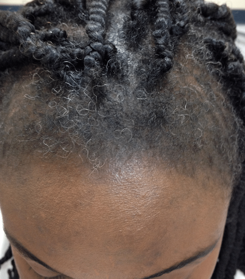 traction alopecia