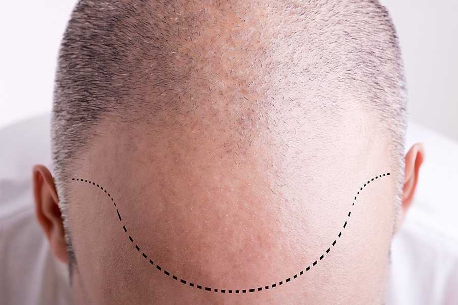 Why Planning Your Hairline Is Essential For Great Transplant Results